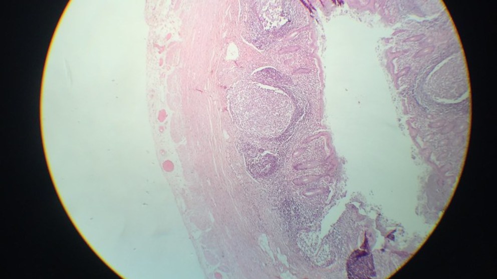 Descubre qué es el apéndice y cuál es su función en nuestro cuerpo