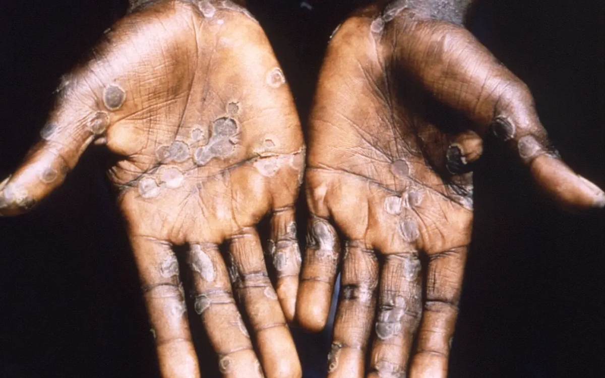 Jalisco confirma 5 casos de viruela del mono