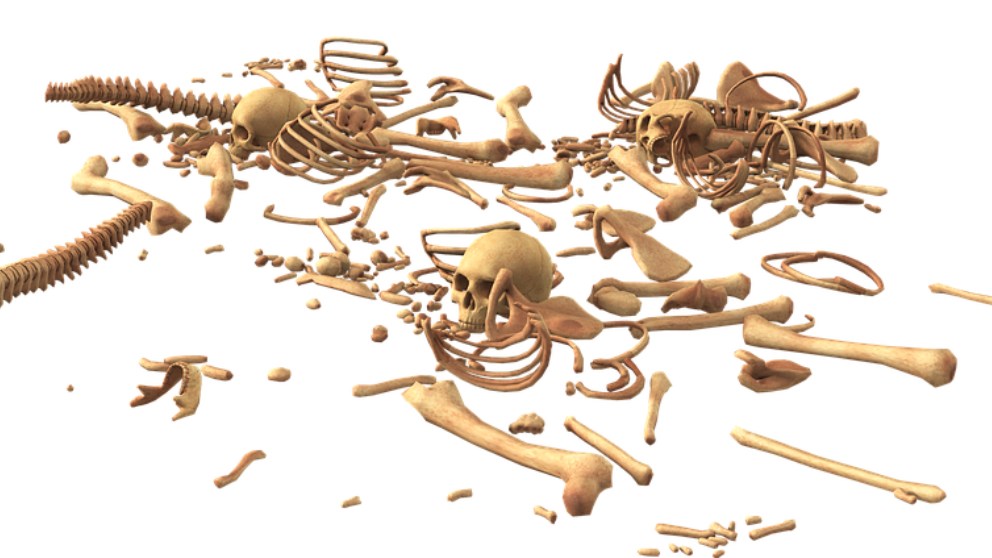 Qué es un quiste óseo y qué tipos hay