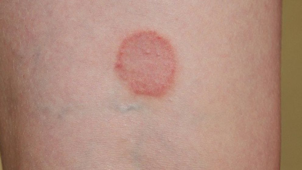 ¿Qué es la tiña y por qué se produce?