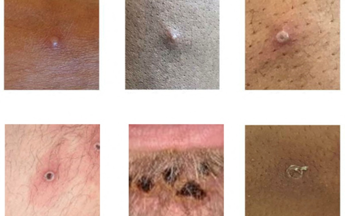 Confirman primer caso de viruela del mono en Oaxaca; es un joven de 27 años