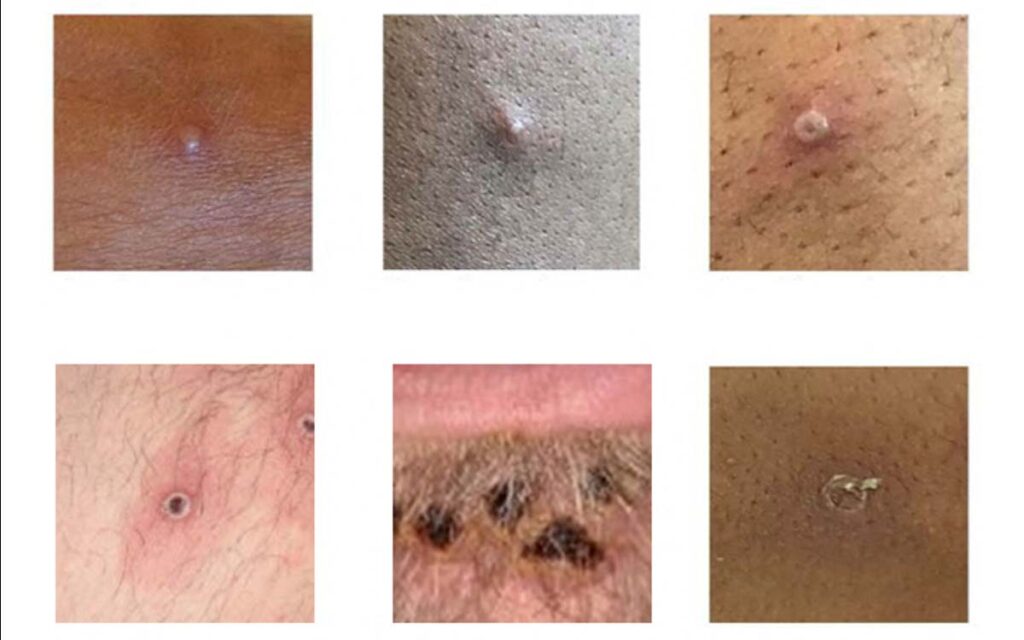 EU reporta 1,048 casos nuevos de viruela del mono en un día; se convierte en el país con más diagnósticos positivos