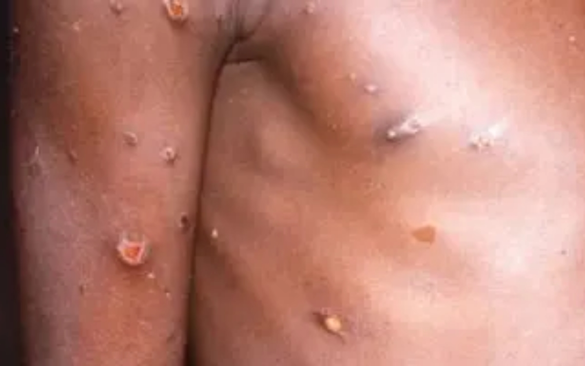 Tabasco reporta su primer caso de viruela del mono