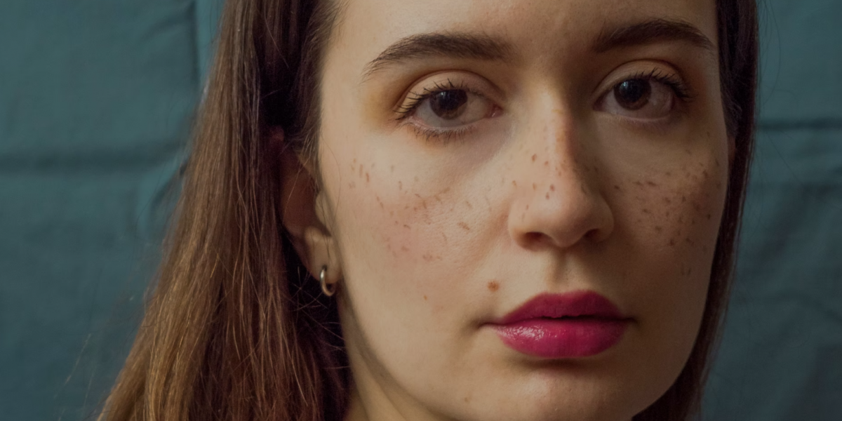Todo lo que debes saber sobre el melasma: causas, tratamiento y prevención