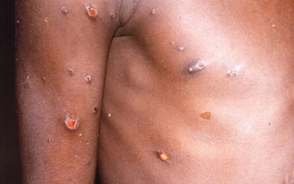 Viruela del mono | Estados Unidos reporta primeros casos en niños