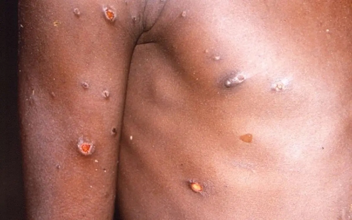 Viruela del mono | Estados Unidos reporta primeros casos en niños