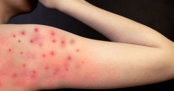 Viruela del mono: la OMS declara al brote como emergencia de salud internacional