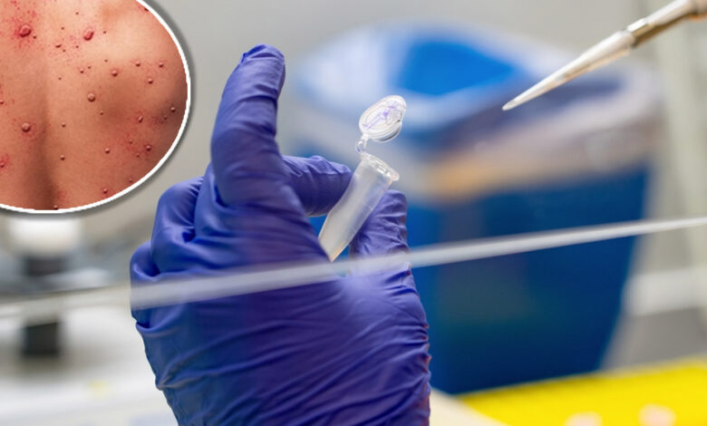 Viruela del mono: la OMS podría declarar la emergencia mundial por el avance del virus