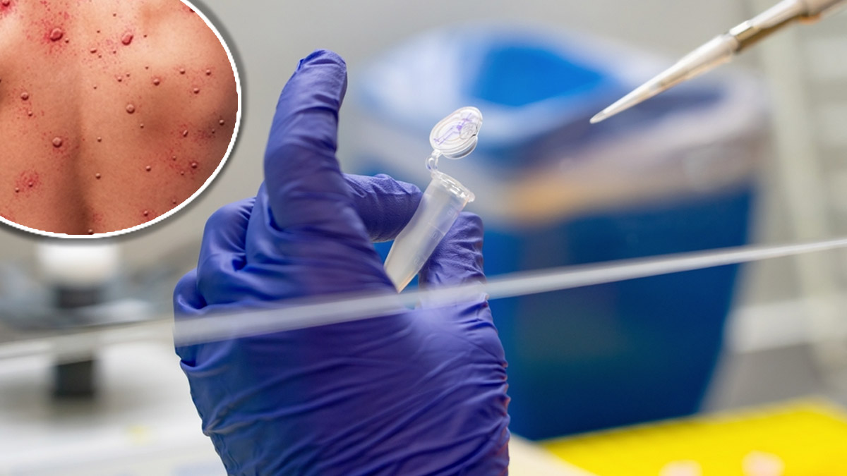 Viruela del mono: la OMS podría declarar la emergencia mundial por el avance del virus