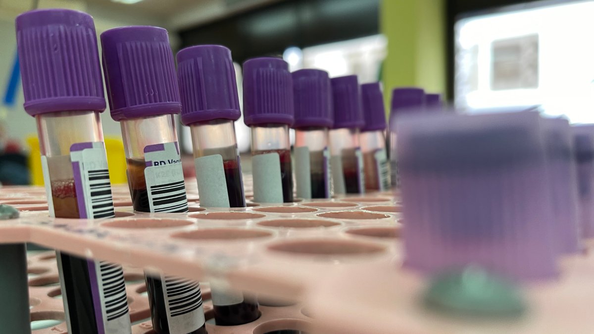 Declaran emergencia local en condado de Los Ángeles por viruela del mono