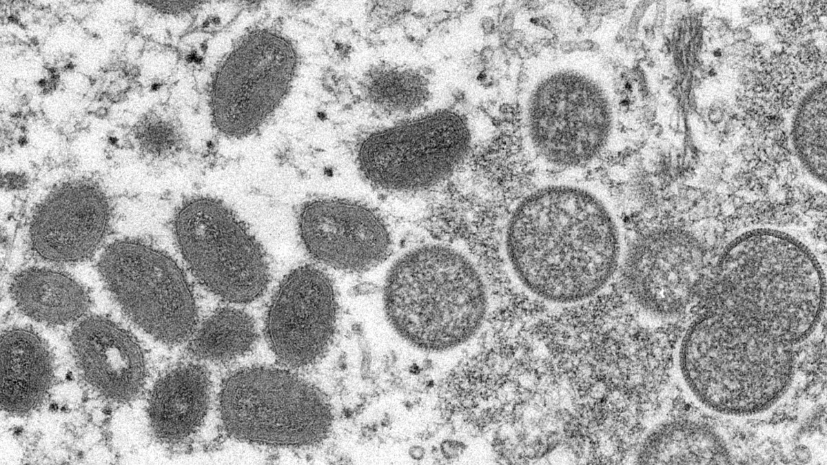 California, bajo declaración de emergencia por la Viruela del Mono