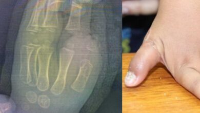 Cirujanos plásticos del IMSS reimplantan dedo pulgar a niño de 1 año tras sufrir accidente