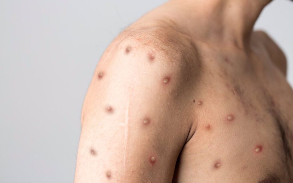 Europa ya supera los 18 mil casos de viruela del mono