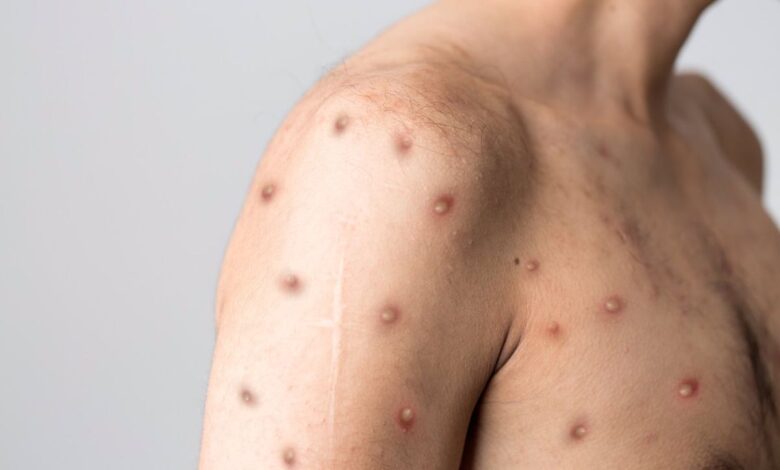 Europa ya supera los 18 mil casos de viruela del mono