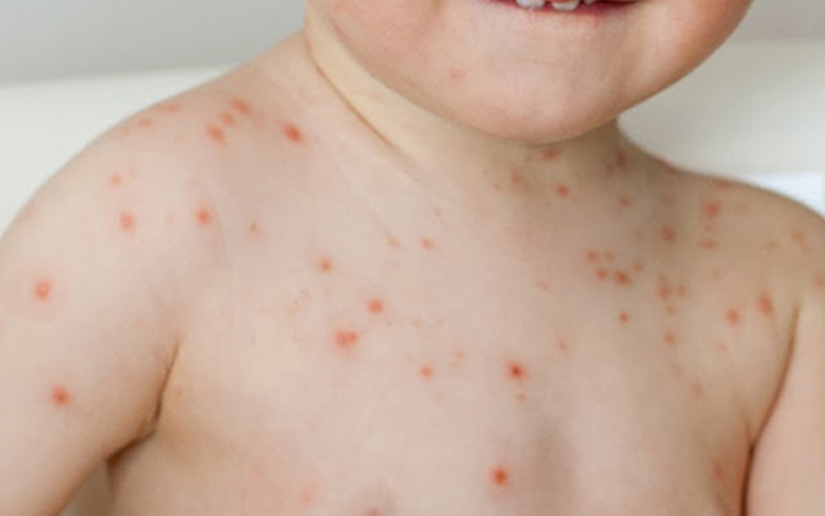 Gripe del tomate el nuevo virus que afecta a niños menores de 5 años detectado en la India