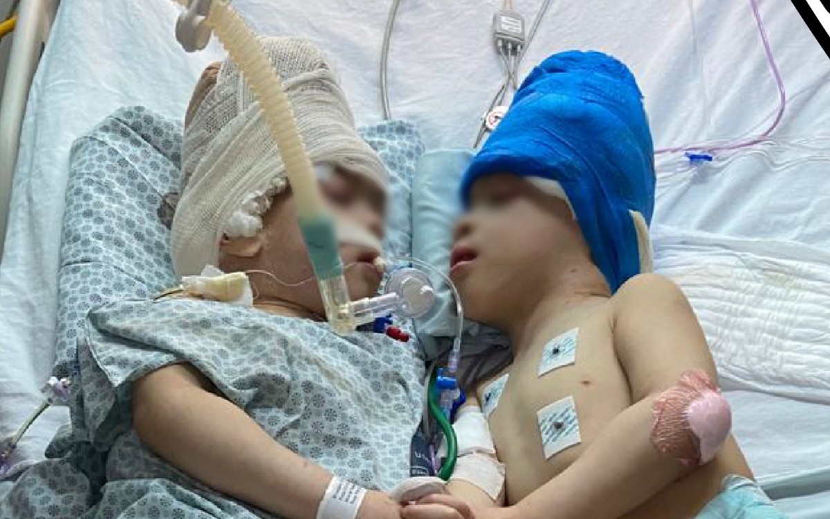 Médicos logran separar a gemelos brasileños unidos por la cabeza con ayuda de realidad virtual