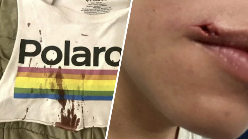 Pareja gay denuncia ataque de odio por la viruela del mono