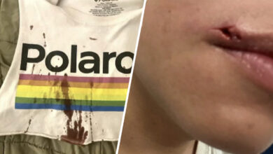 Pareja gay denuncia ataque de odio por la viruela del mono