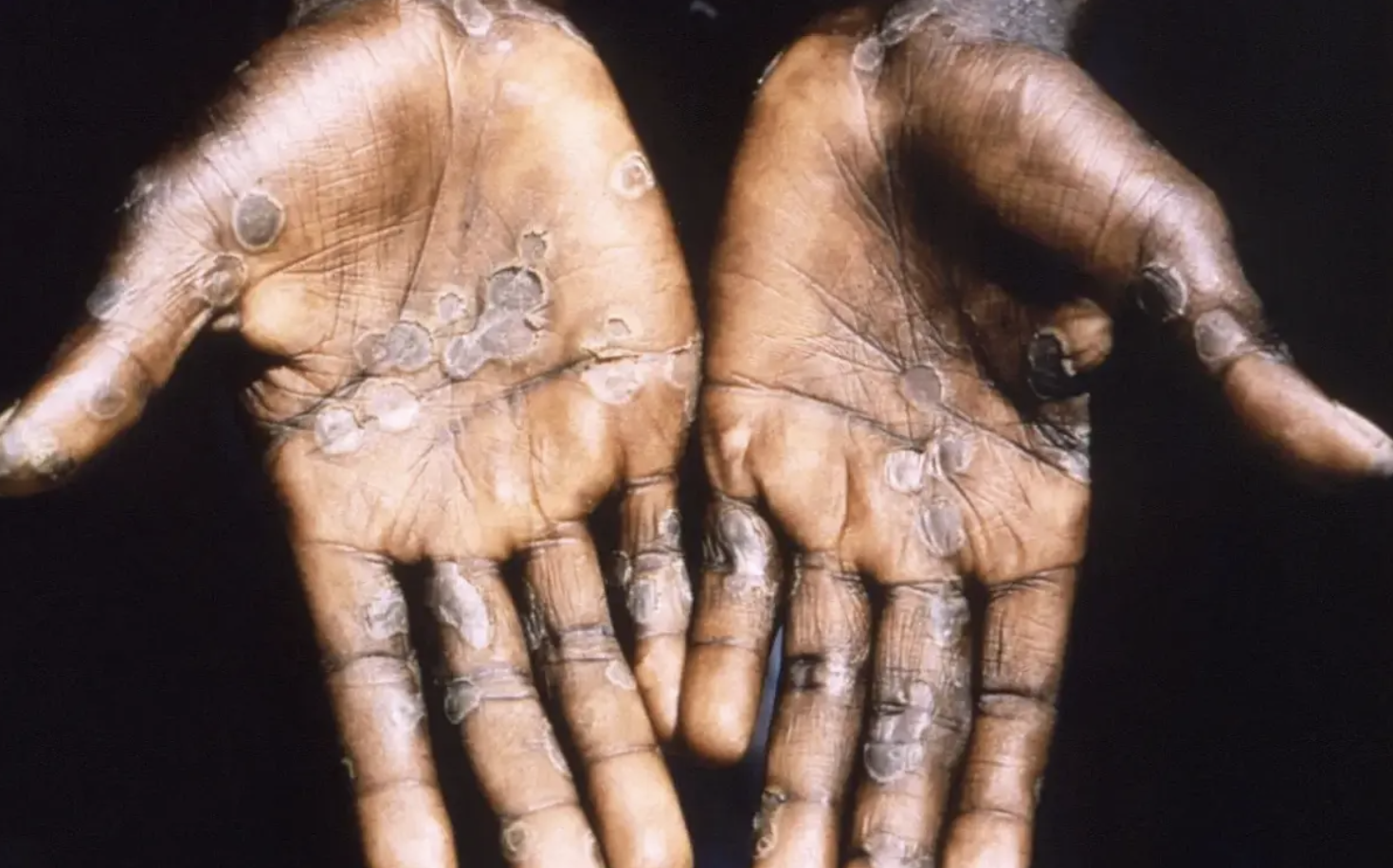 Viruela del mono en África no se concentra en hombres homosexuales como en otras partes del mundo: OMS