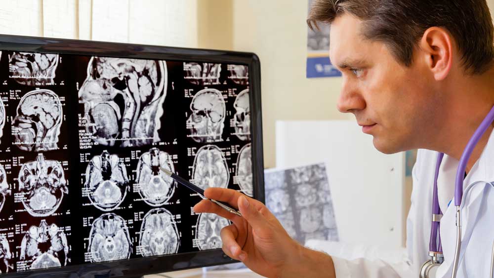 ¿Grabarse el cuello con el teléfono? El video que te alertaría del riesgo de un derrame cerebral, según estudio