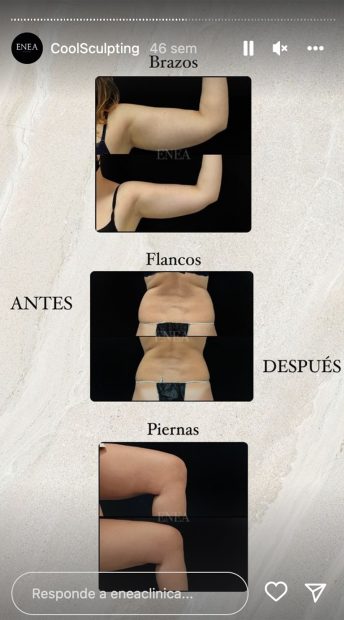 Coolsculpting / Instagram