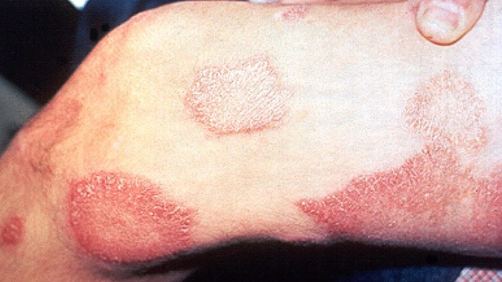 Día Mundial de la Lepra 2019: ¿Una enfermedad erradicada?