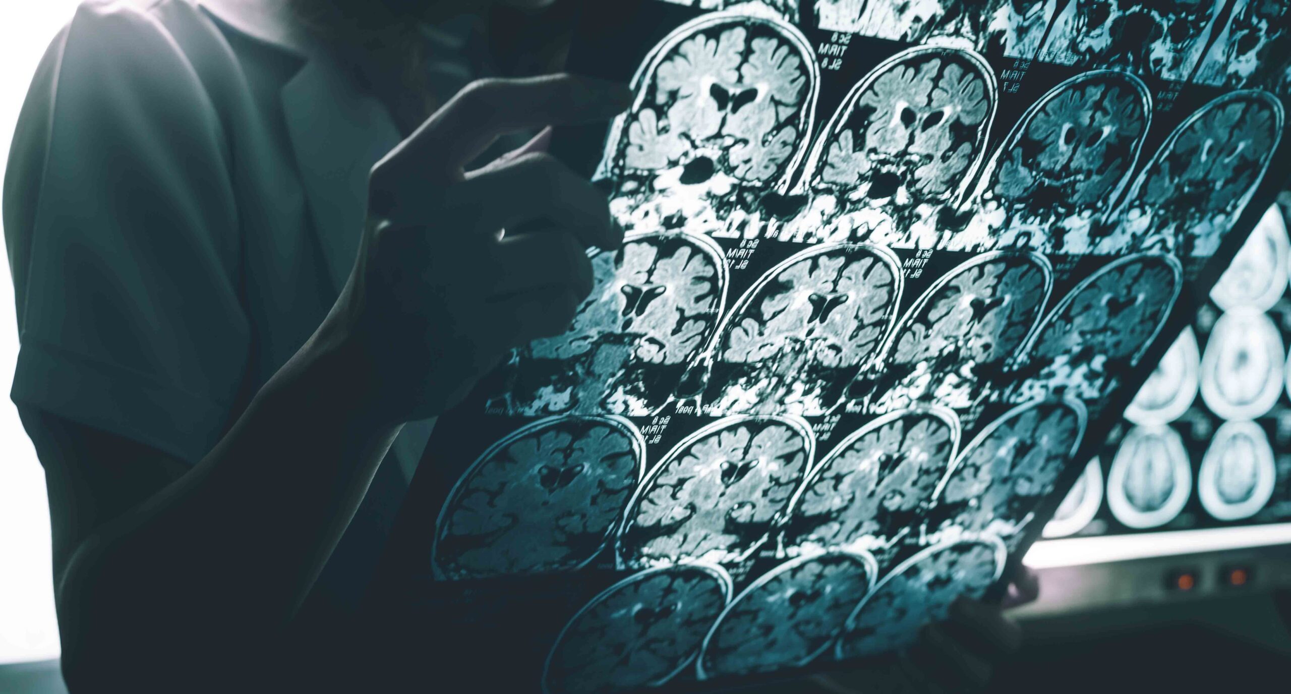 Este es el tiempo que puede tardar un diagnóstico de Alzheimer en México, según especialista