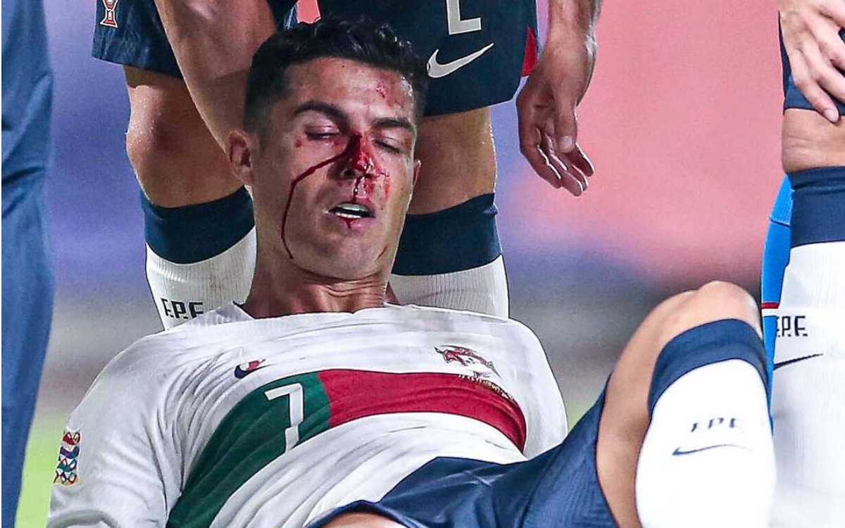 Un sangrante Cristiano Ronaldo se rehusa a abandonar partido contra República Checa | Video