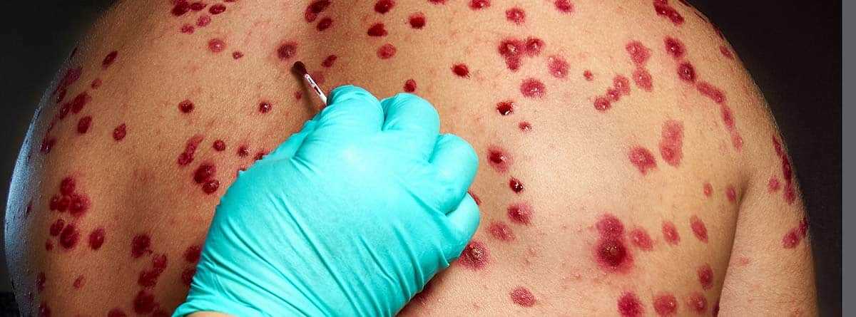 México suma mil 627 casos de viruela del mono