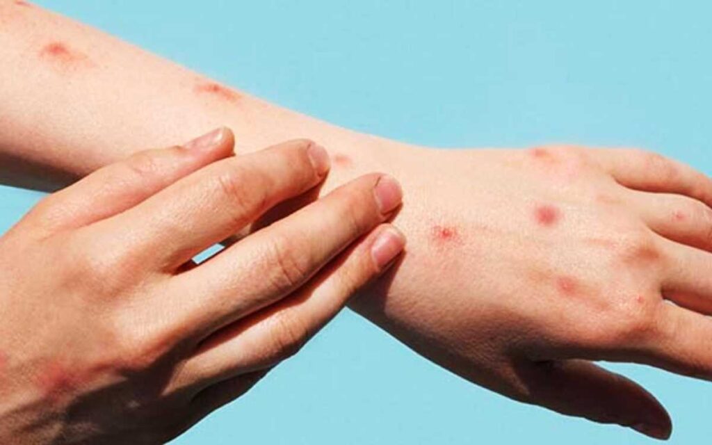 Confirman 2 mil 468 contagios de viruela símica en México