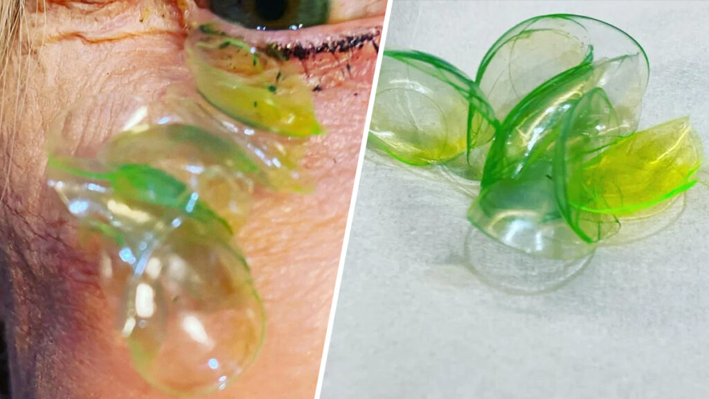 Mujer tenía 23 lentes de contacto debajo de su párpado, dice la oftalmóloga