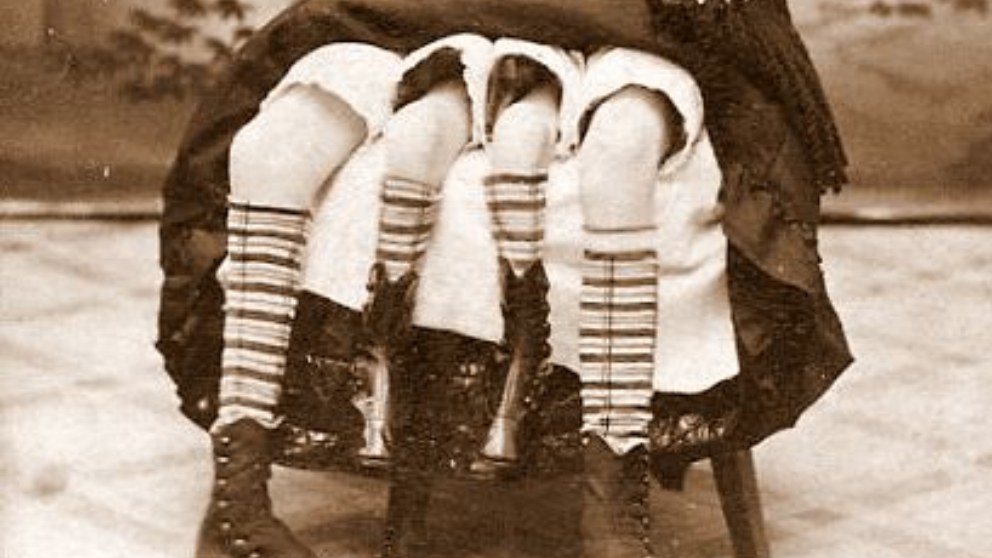 Myrtle Corbin, todo sobre la niña de las 4 piernas