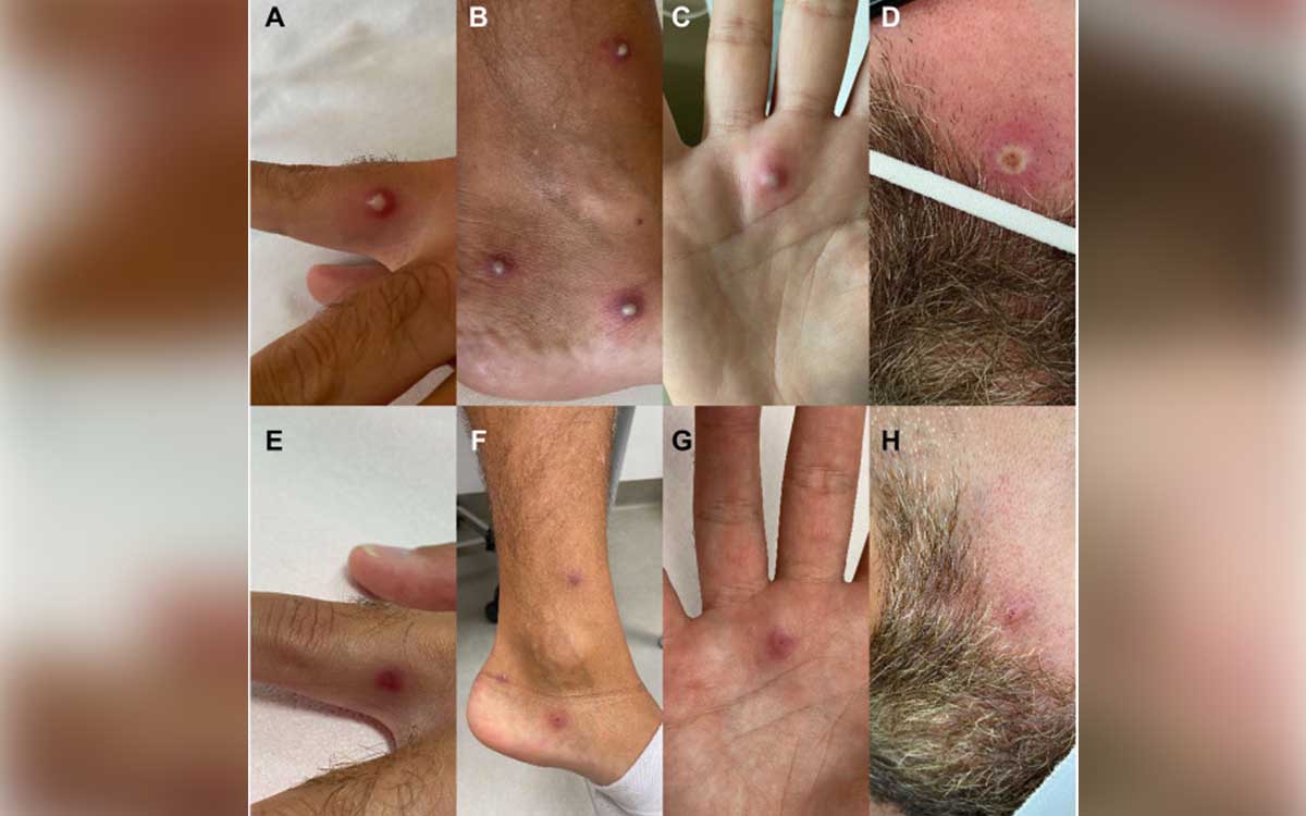 Reportan mil 968 casos de viruela del mono en México