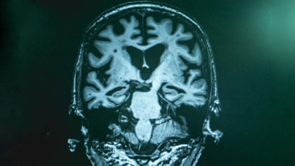 Estudio demuestra que la mala calidad del sueño provoca un alto riesgo de desarrollar esta enfermedad