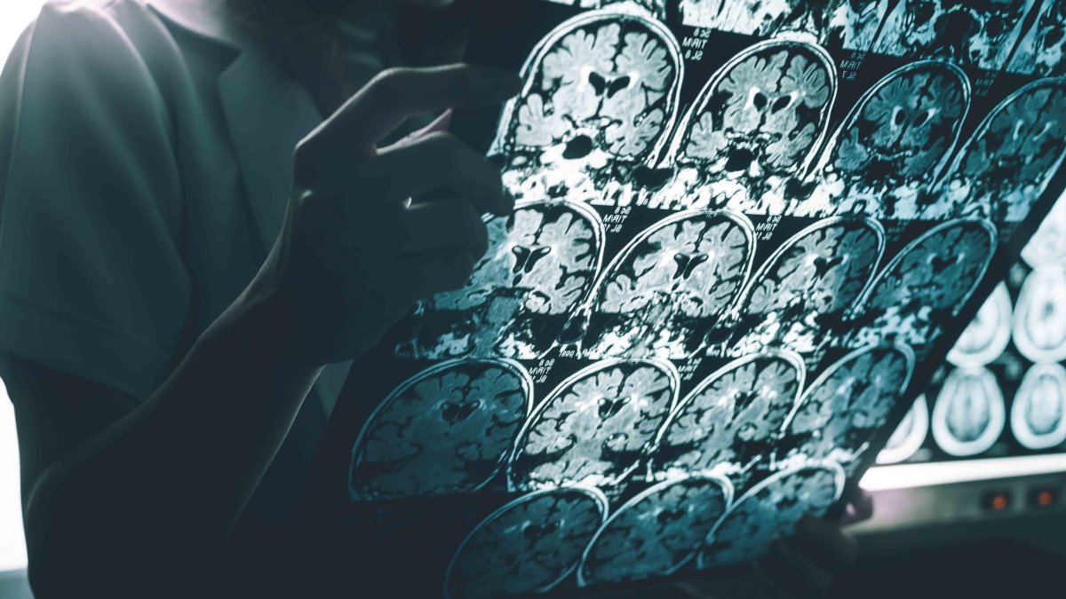 Fármaco experimental muestra eficacia contra el alzhéimer, según un estudio