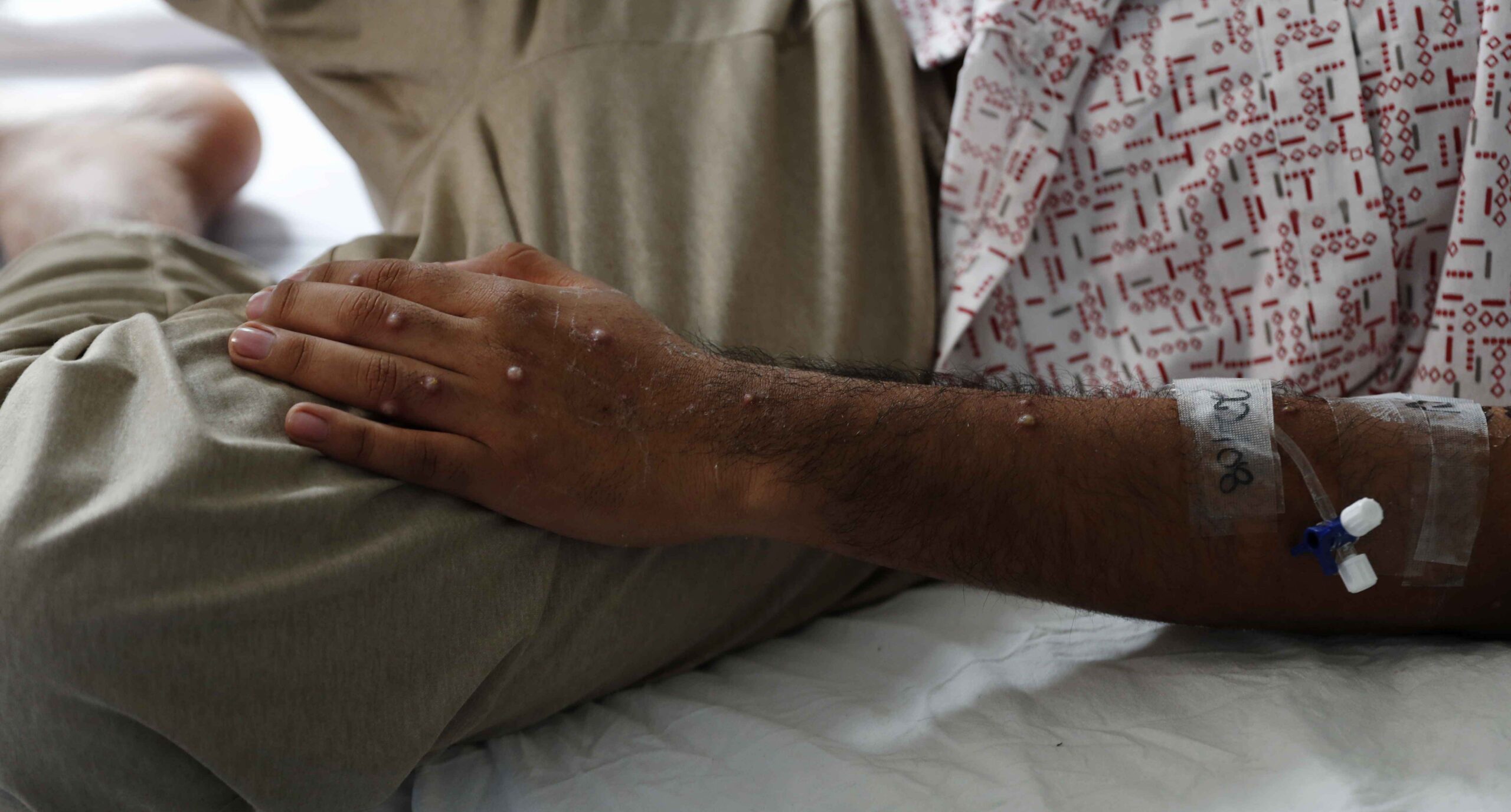 Confirman segunda muerte por viruela del mono en Chile