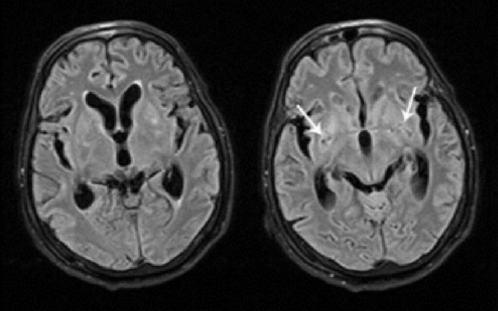 1,400 mujeres recibirán tratamiento por meningitis en Durango