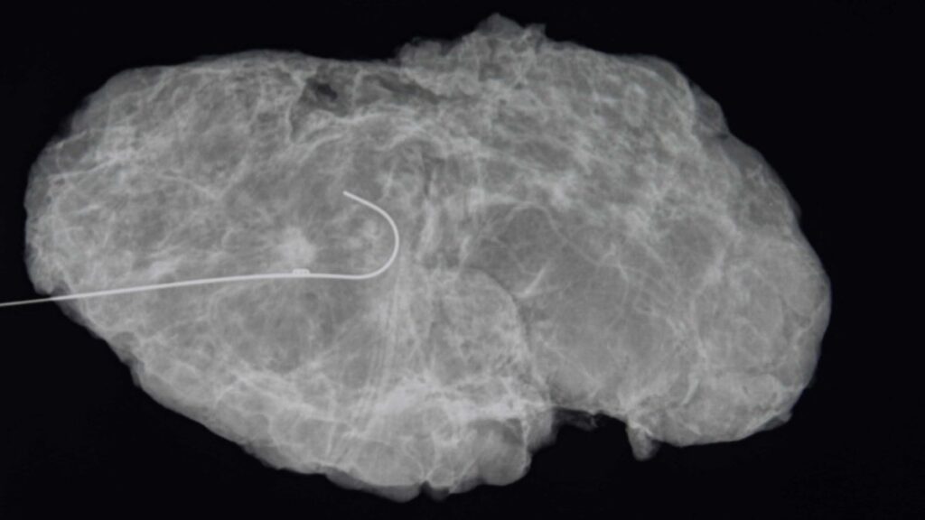 Ahora más pacientes de cáncer de mama pueden descartar la mastectomía y optar por esta cirugía