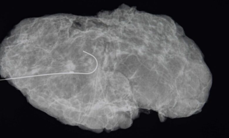 Ahora más pacientes de cáncer de mama pueden descartar la mastectomía y optar por esta cirugía
