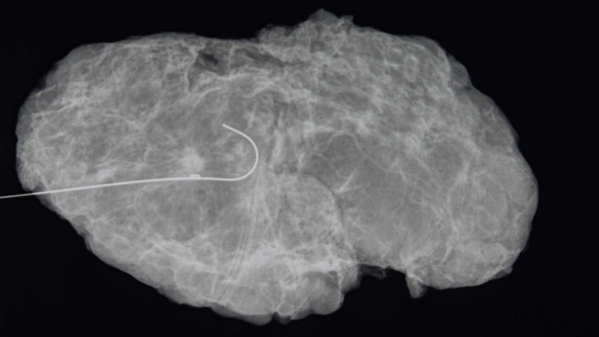 Ahora más pacientes de cáncer de mama pueden descartar la mastectomía y optar por esta cirugía