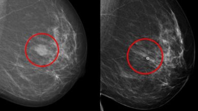 Ahora hay un nuevo método que identifica el mejor fármaco para cada paciente con cáncer de mama
