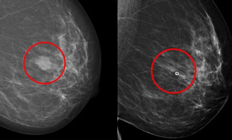 Ahora hay un nuevo método que identifica el mejor fármaco para cada paciente con cáncer de mama