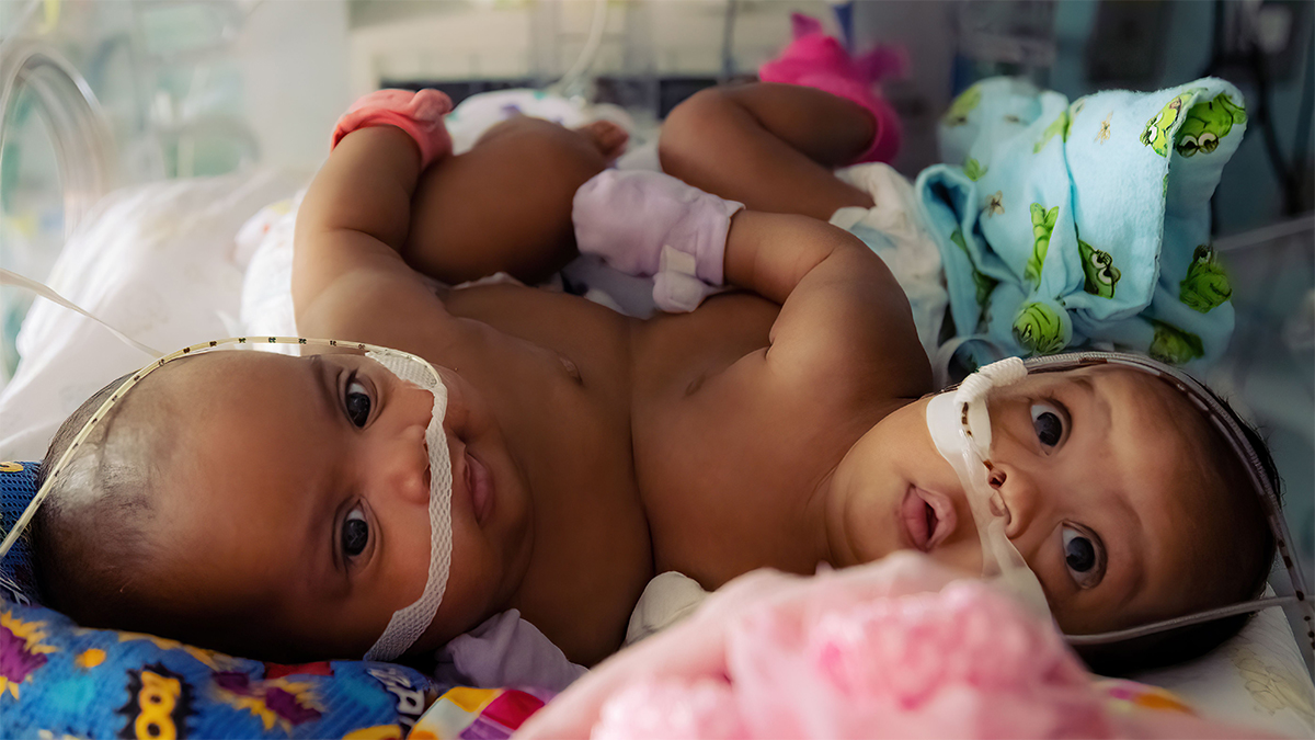 Exitosa separación de siamesas en hospital de Fort Worth, Texas