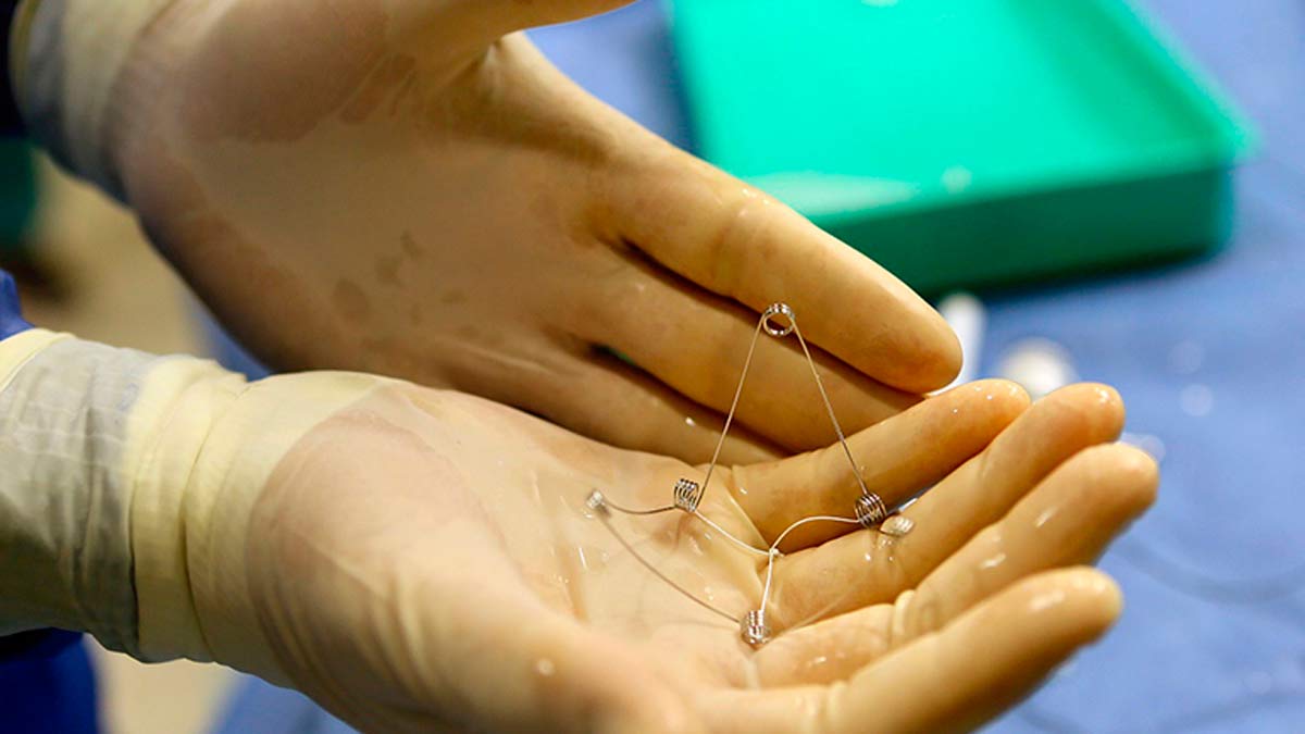 El novedoso implante que puede evitar los paros cardíacos