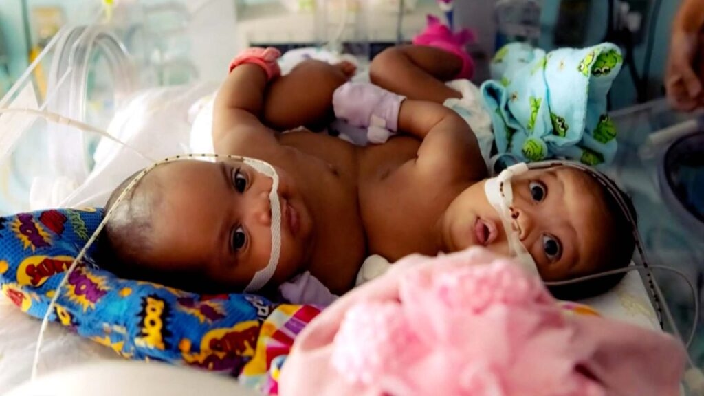 hospital infantil realiza “rara” separación de siameses