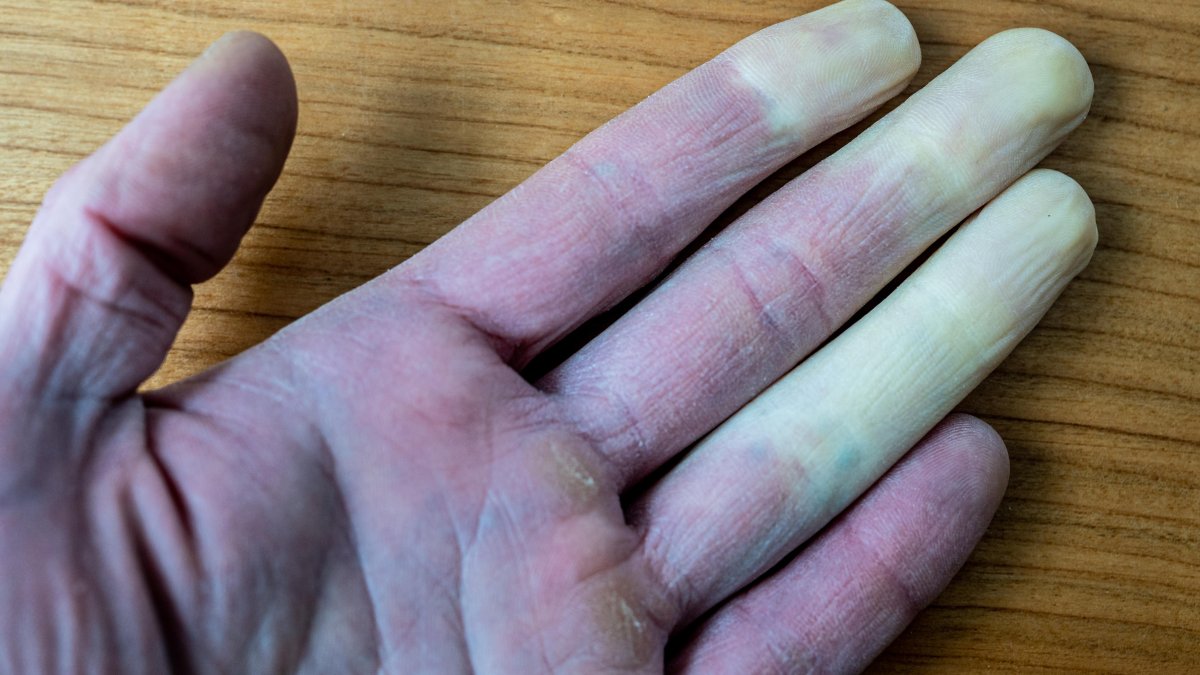 ¿Qué es la enfermedad de Raynaud? Estos son los dos tipos