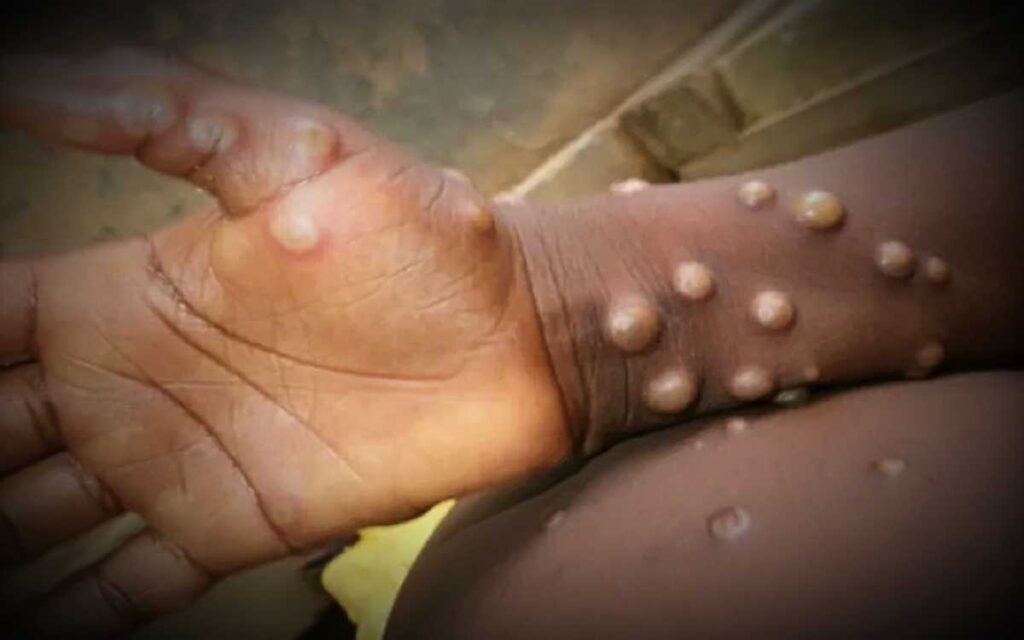 Confirman 49 caos de viruela símica en México