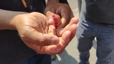 Amputan dedo a manifestante lesionado por seguridad del Congreso de Morelos