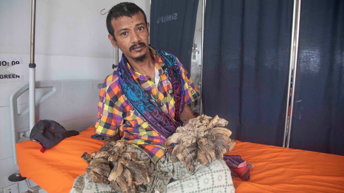 Cuatro años después, el “hombre árbol” vuelve a vivir un doloroso calvario