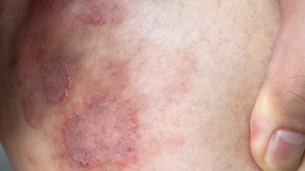 Detectan casos de Tiña en Nueva York, una infección de piel que resiste a medicamentos